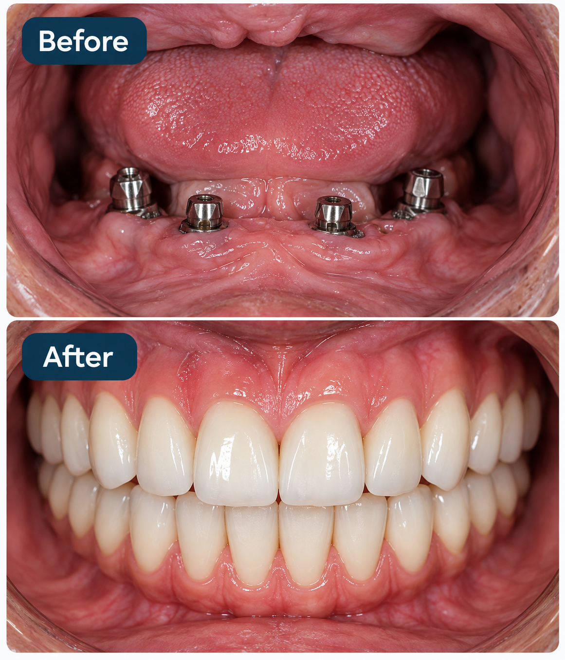 Full Mouth Implant Rehabilitation Before and After