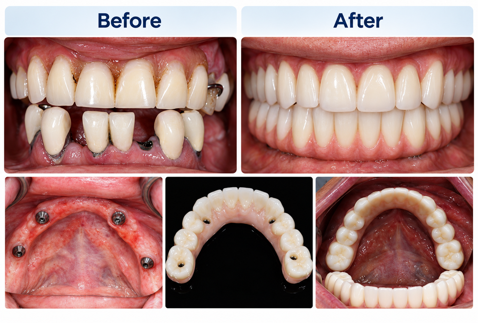 Before and after dental implant treatment
