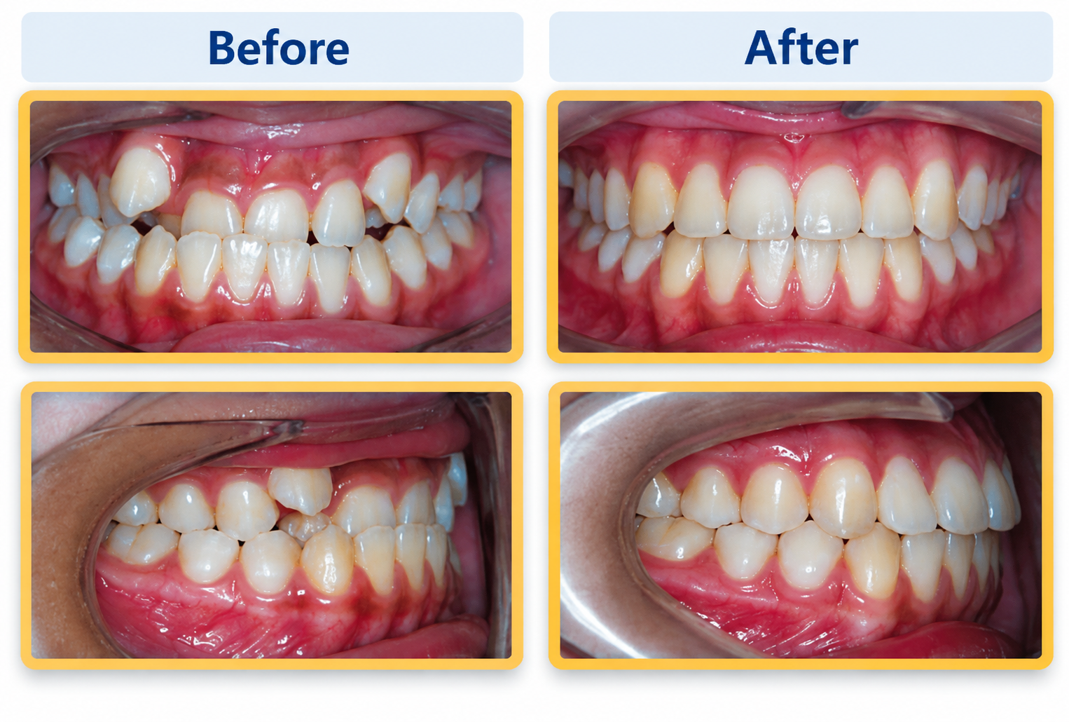 Before and after orthodontic treatment