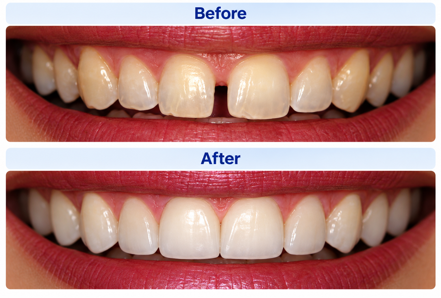 Before and after cosmetic dental treatment